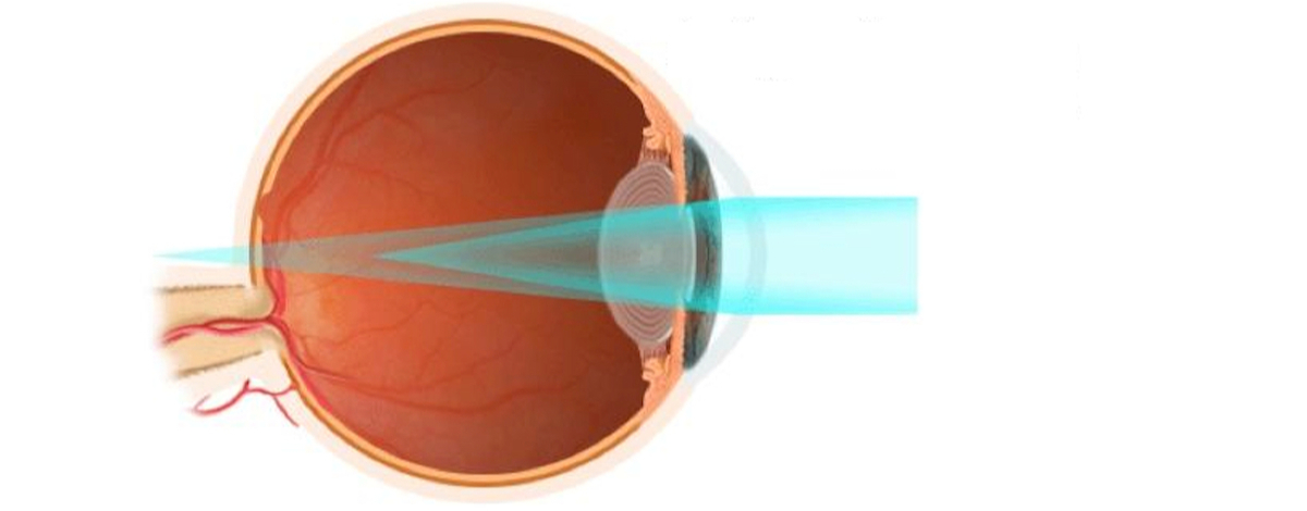 astigmatismo è un difetto di curvatura della cornea