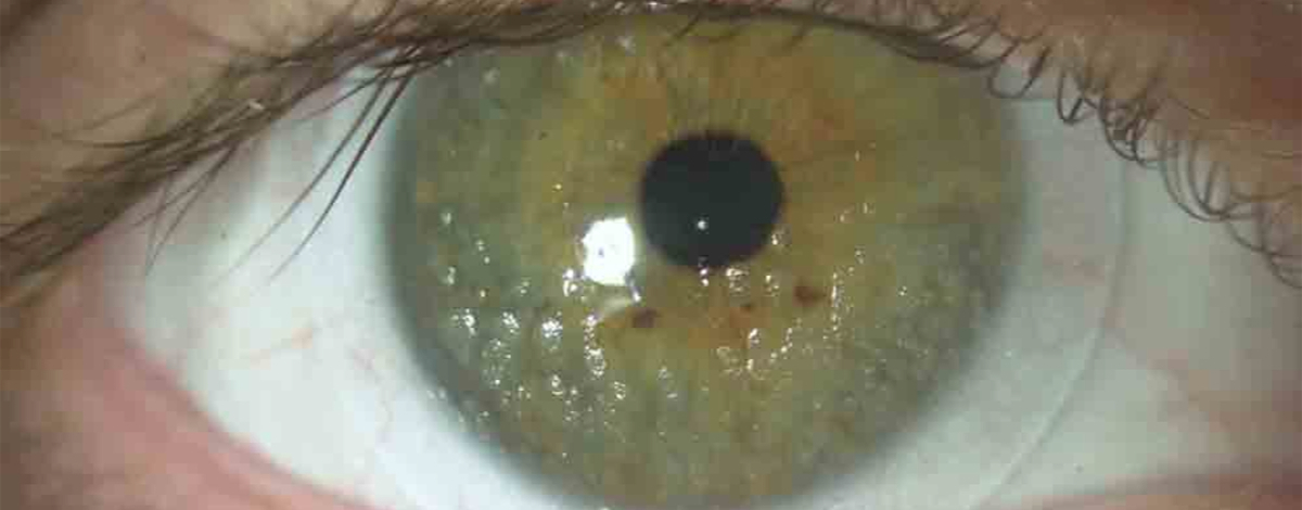 cheratite da lente a contatto