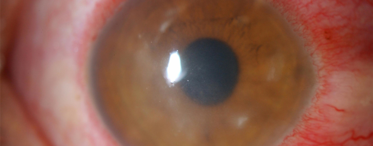 cheratite superficiale