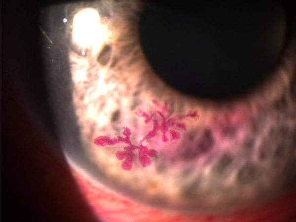 la cheratite è una infiammazione della cornea
