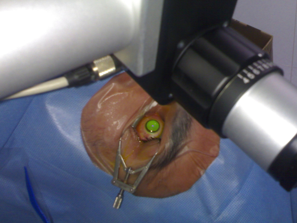 il cheratocono si può prevenire con crosslinking