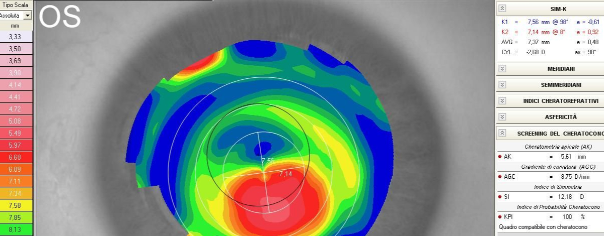 il cheratocono è una malattia congenita della cornea