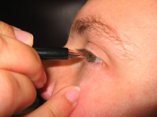 la pachimetria corneale mette in evidenza assottigliamento della cornea