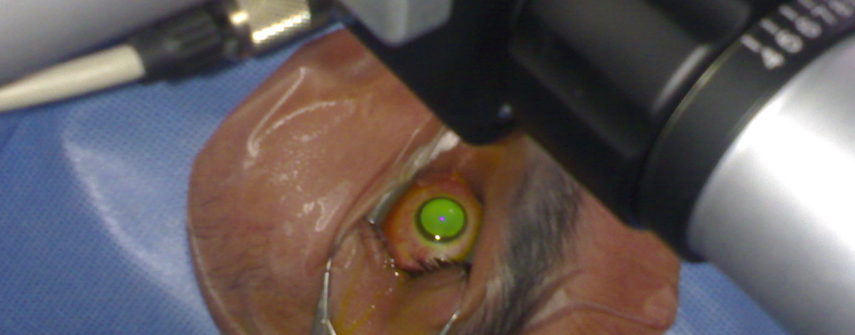 il cheratocono si può prevenire con il crosslinking