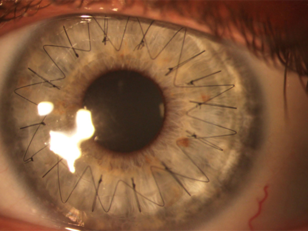 il cheratocono si può correggere con il trapianto della cornea