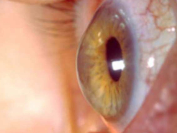 il cheratocono è un assottigliamento della cornea
