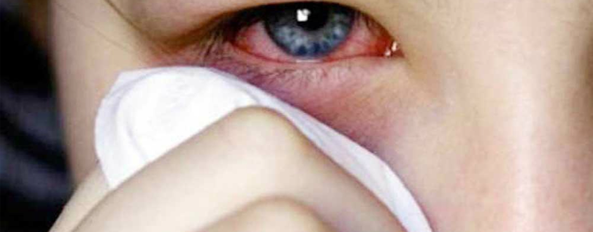 cause della congiuntivite