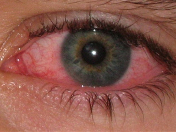 congiuntivite batterica