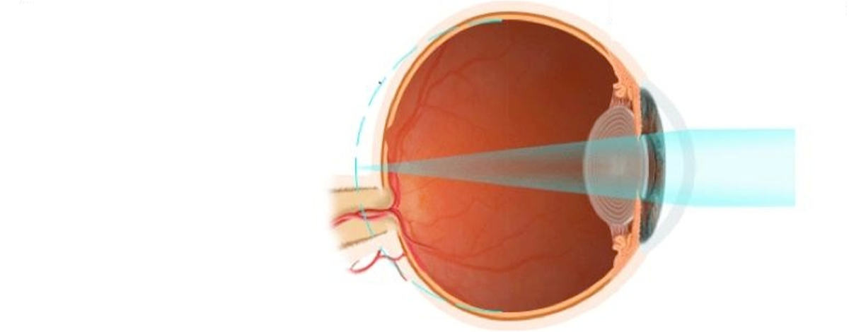 nella ipermetropia il buolbo è più corto