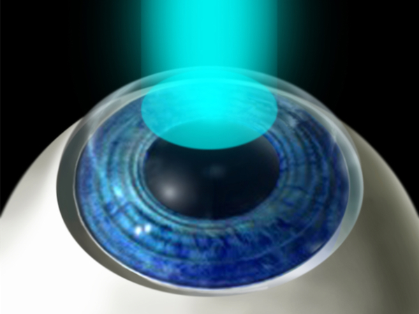 ipermetropia può essere corretta con il laser