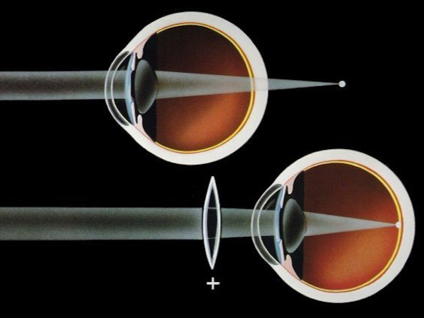 ipermetropia è un difetto rifrattivo