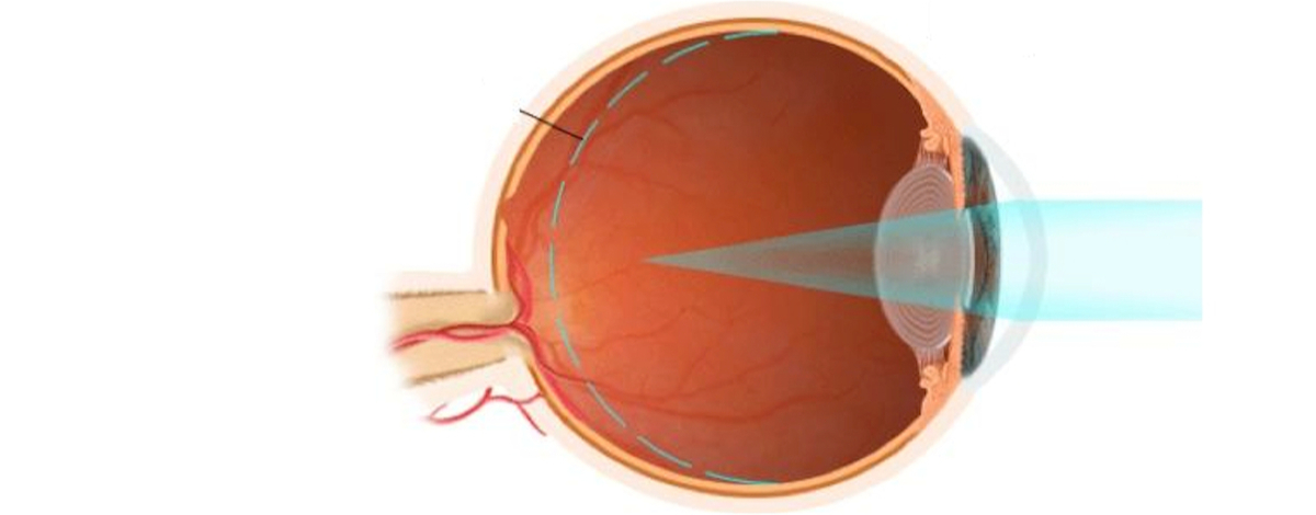 la miopia è causa di un bulbo oculare più lungo