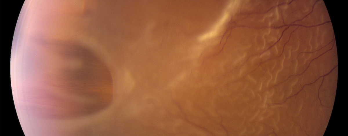 i iopi elevati spesso soffrono di complicanze retiniche