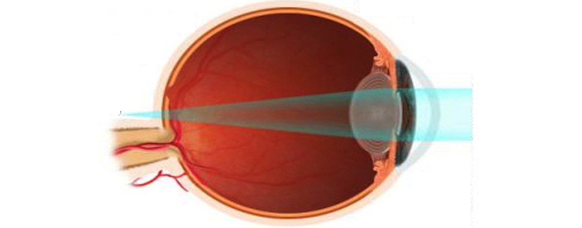 la presbiopia risulta dalla pedita di elasticità del cristallino