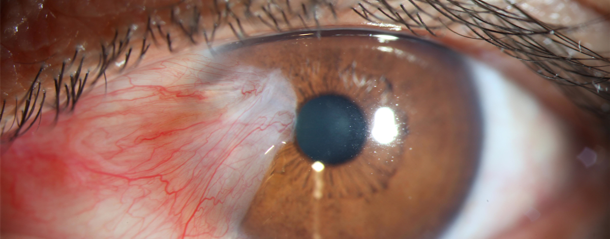 pterigio può causare calo della vista