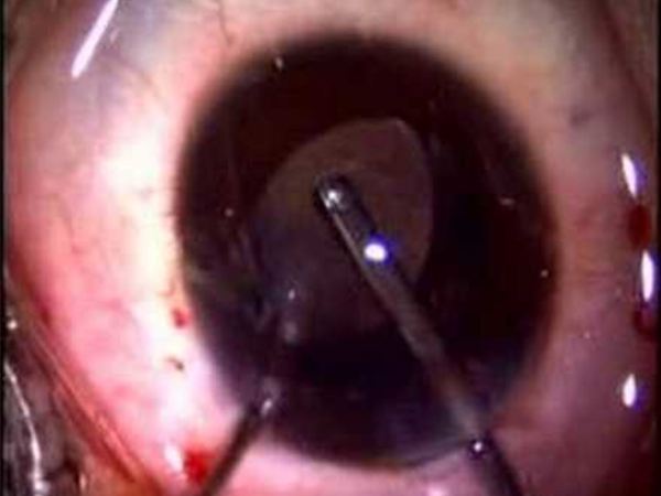 la chirurgia della cataratta nei bambini