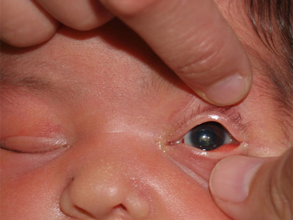 la diagnosi della cataratta nei bambini