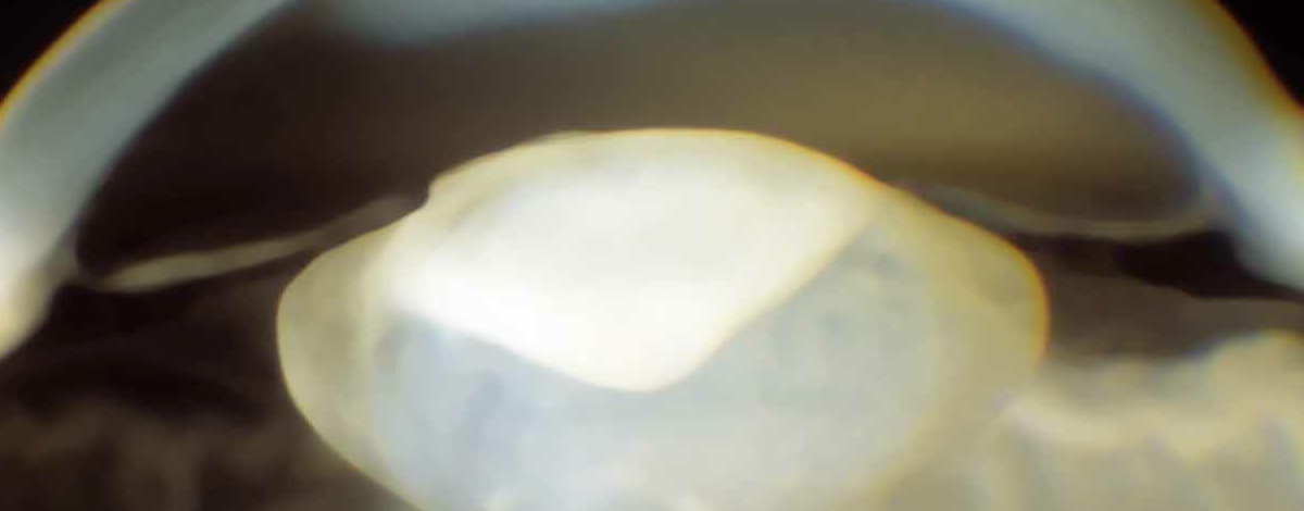 come si sviluppa la cataratta nei bambini