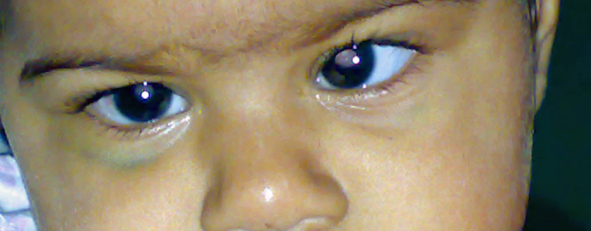 come si previene la cataratta nei bambini