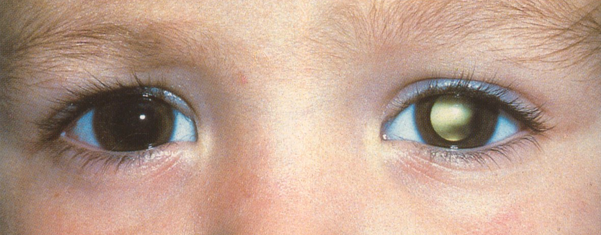 i sintomi della cataratta nei bambini