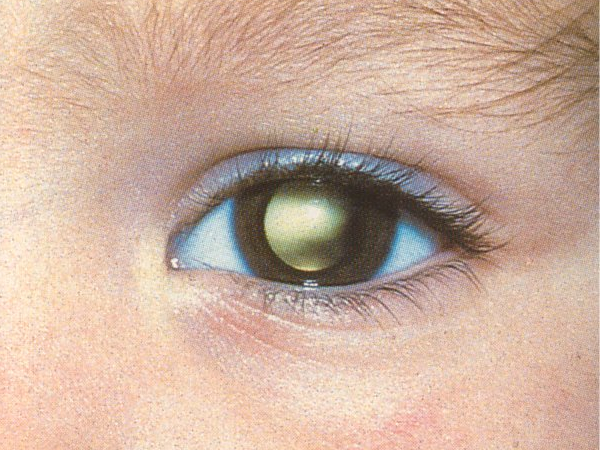 la cataratta nei bambini