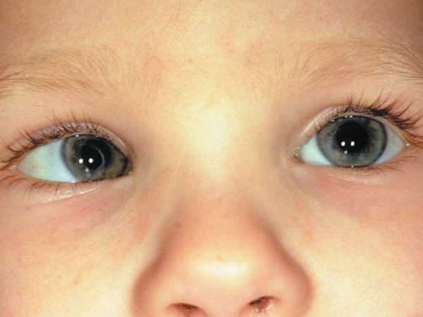 deviazione degli occhi nei bambini