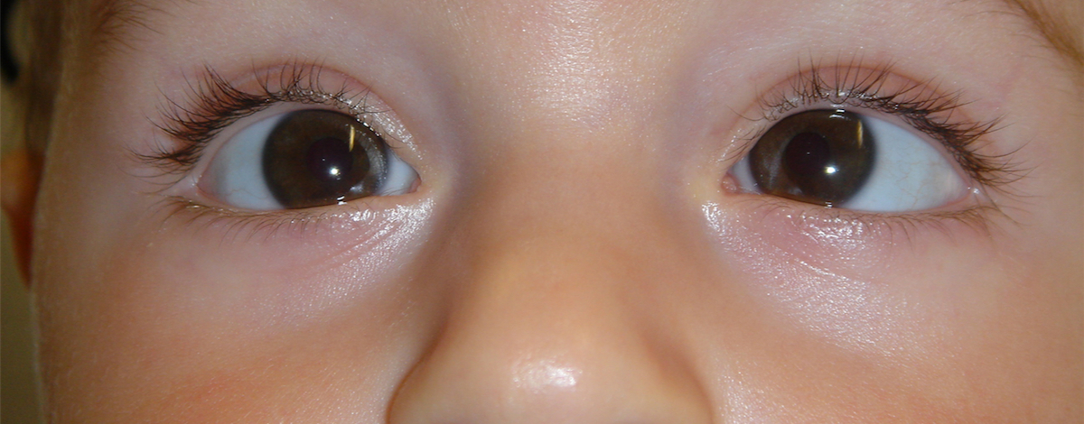 lo strabismo nei bambini