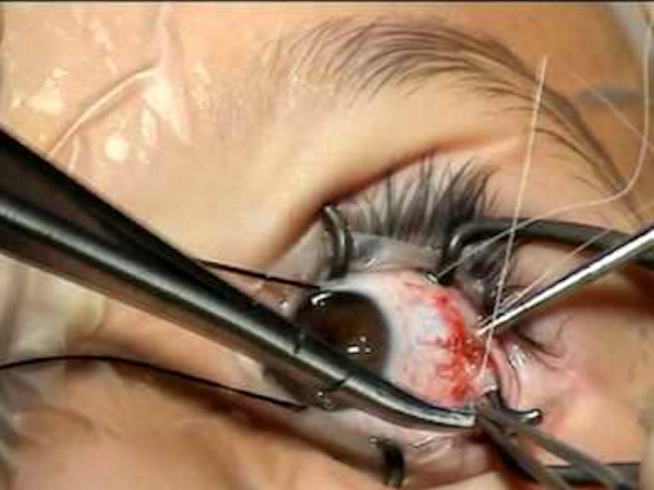 trattamento dello strabismo con la chirurgia