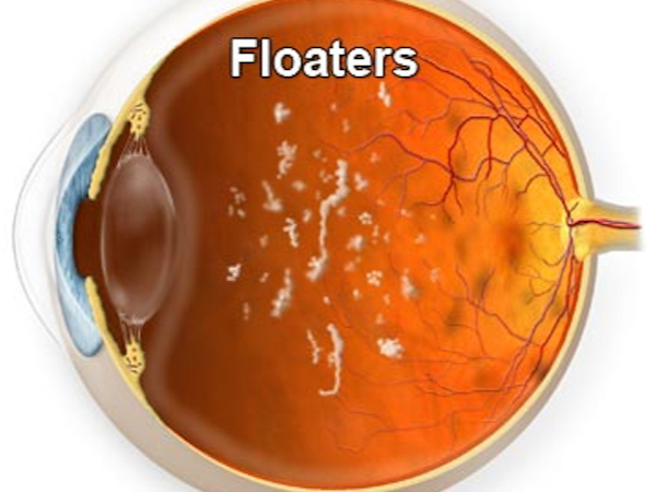 corpi mobili vitreali