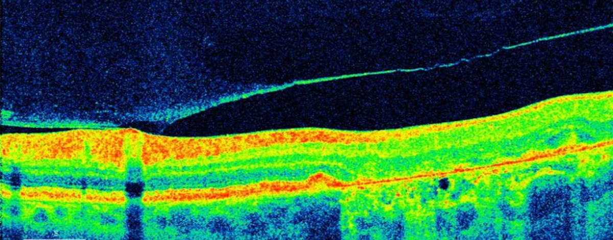 perchè si producono i corpi mobili vitreali