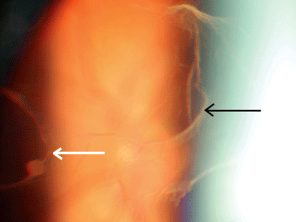 esame del fondo oculare