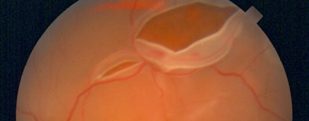 rottura retinica trazionale post distacco posteriore del corpo vitreo