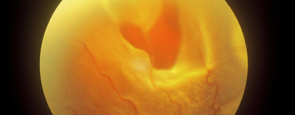 rottura retinica nel distacco di retina