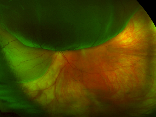 esame del fondo oculare nel distacco di retina