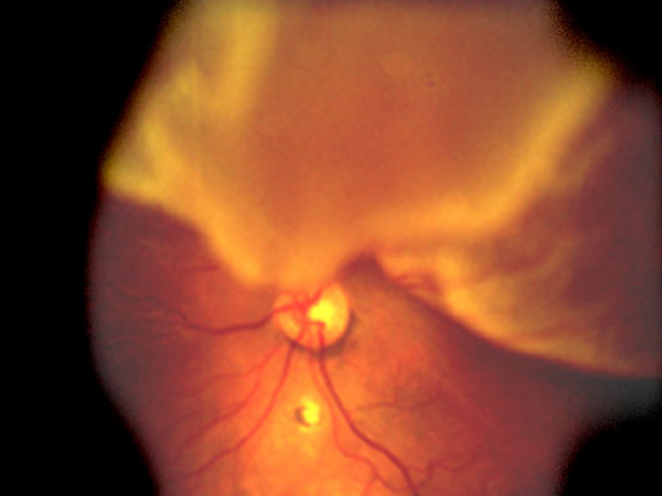 distacco della retina