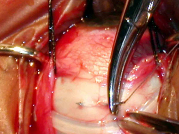 chirurgia episclerale per distacco della retina