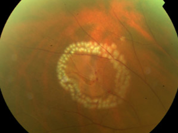 laser retinico su rottura 