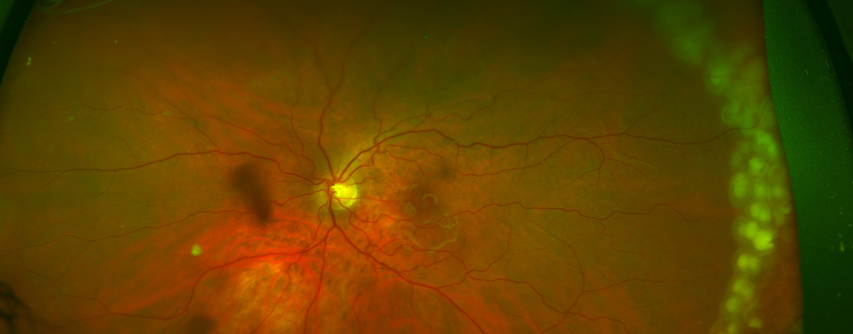 laser retinico in rottura retinica