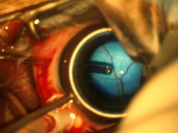 vitrectomia per il distacco di retina