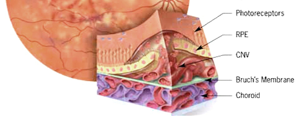 come si forma la degenerazione maculare