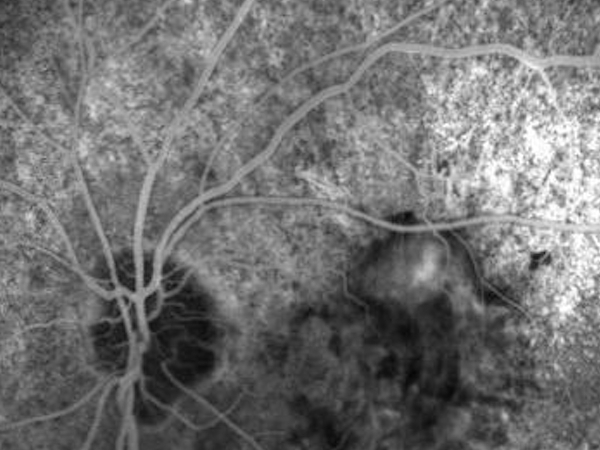 fluorangiografia retinica nella degenerazione maculare senile