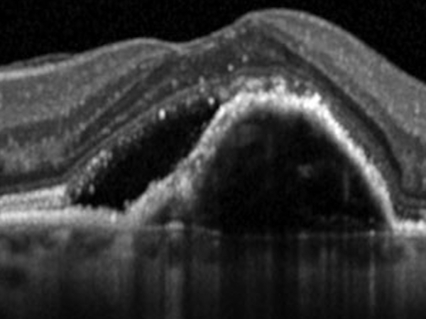 OCT nella degenerazione maculare senile