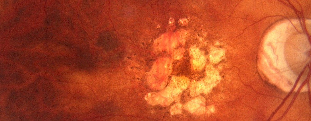 prevenzione della degenerazione maculare senile