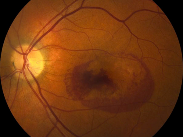 degenerazione maculare emorragica