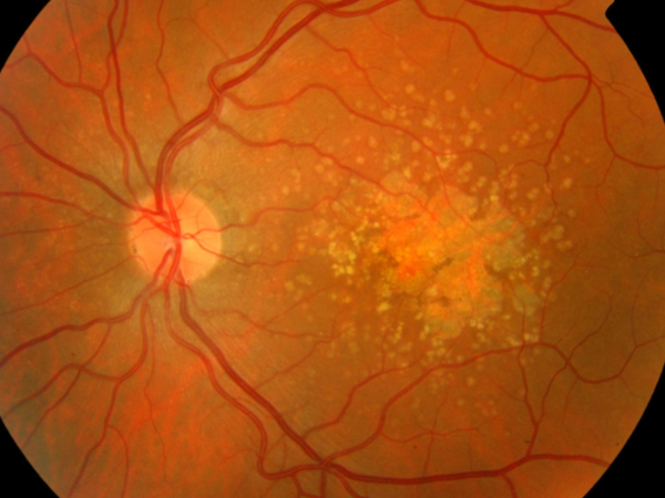 complessi vitaminici nella degenerazione maculare senile