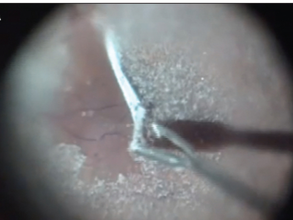 vitrectomia nella membrana epiretinica