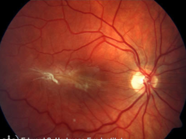 membrana epiretinica