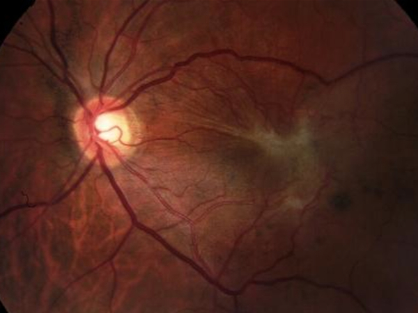 esame specialistico della membrana epiretinica