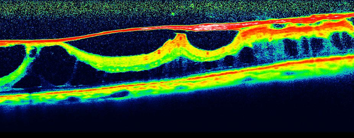 evoluzione della membrana epiretinica
