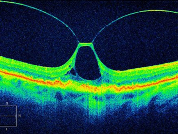esame oct della membrana epiretinica